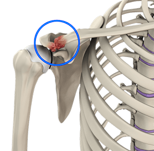 https://www.benservicemd.com/3d-images/acromioclavicular-ac-joint-osteoarthritis.png